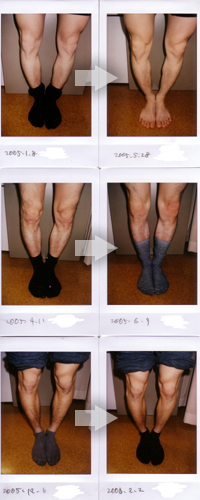 Ｏ脚の改善例写真2
