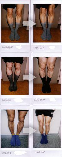 Ｏ脚の改善例写真6