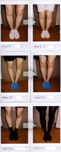 Ｏ脚の改善例写真7