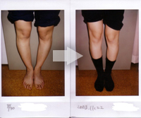 Ｏ脚の改善例写真10