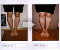 Ｏ脚の改善例写真11