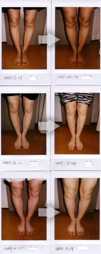 Ｏ脚の改善例写真1