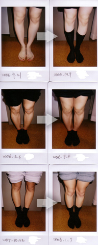 Ｏ脚の改善例写真4